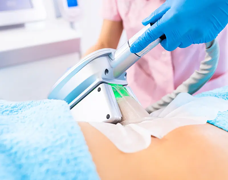 Cryolipolyse